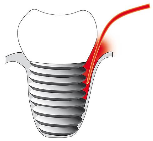Bild Implantatentzündung / © Cumdente Bild Implantatentzündung / © Cumdente