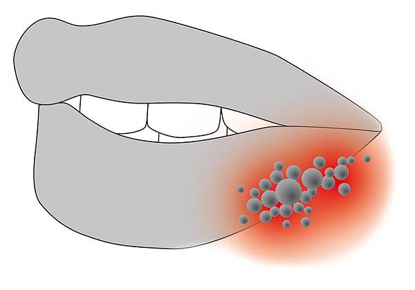 Bild Lippenherpes / © Cumdente Bild Lippenherpes / © Cumdente